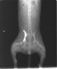 写真4:恥骨の骨折は整復しなくて良い。本症例では腸骨を整復することで骨盤全体がほぼ元の位置に戻っている。