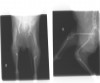写真5:膝蓋骨脱臼では滑車溝を深くし、関節包を縫縮するが、脛骨粗面の転位・移植術をしなければ治療にならない。ワイヤーが移植面を固定している。