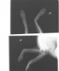 写真6:写真5の症例3のチワワで、2ヶ月前に先天性膝蓋骨脱臼で両後肢を手術していた。前腕を片側ずつ骨折する事は有るが、両側同時の骨折は珍しい。