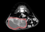 CT検査 赤丸で囲った部分が脾臓腫瘤