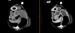 左:単純CT。 右:造影CT。