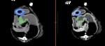 左:単純CT。 右:造影CT。 青丸→異物。 緑→幽門付近の粘膜不整。