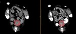 左:単純CT。 右:造影CT。 赤丸→副腎腫瘍。