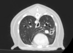 CT検査(肺)