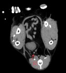 CT① 赤い矢印が右側尿管の頭側(腎盂側)に存在する尿管結石(1個目)。