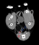 CT② 赤い矢印が右側尿管に存在した2個目の結石。青矢印は左尿管の結石。