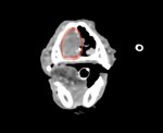 CT検査② 軸位断 赤丸:腫瘤
