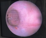 摘出後の内視鏡検査における幽門洞。胃壁が赤く炎症を起こしており、出血斑も見られた。