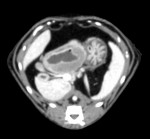 症例26 CT検査 十二指腸の腫瘤病変が認める