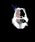 CT 赤線:左鼻腔内不透過性亢進 青矢印:鼻甲介の骨融解