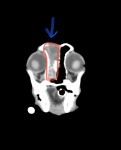 CT 赤線:左鼻腔内不透過性亢進 青矢印:鼻甲介の骨融解