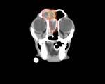 CT 黄色:左前頭洞内の腫瘤病変