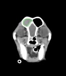  CT 緑線:前頭洞内液体貯留