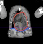 CT③ 青線:横隔膜があるべきライン 赤丸:胸腔内へ逸脱している小腸、脂肪