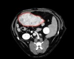 CT静脈相:赤丸→肝臓腫瘤。