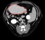 CT平衡相:赤丸→肝臓腫瘤。平衡相で他の肝臓と造影具合が近いことから結節性過形成や腺腫など良性の可能性が考えられる。