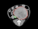 CT① 赤丸:腫瘤 緑:後大静脈