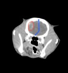 CT検査② (脳腫瘍 造影剤あり):赤丸は脳腫瘍(髄膜腫)を疑う所見。青線はその病巣による脳実質の圧迫像。