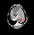 造影CT検査 門脈相 赤矢印:シャント血管