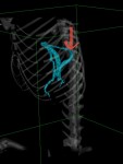 CT画像を基に3D像 赤矢印:シャント血管