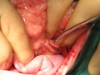 写真5:症例3。4歳半の♀のM・ダックスフント。開腹して目視でシャント血管を確認後、短絡血管を周囲組織から分離する。写真は分離前。本症例の術前血中NH3濃度は234μg/dlであった。