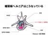 HansenⅠ型の模式図。内部の髄核が上方(背側)に脱出し、脊髄を圧迫している。(イラスト:小川篤志)